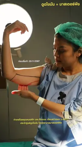 หมอพีทจัดให้จากแขนย้วย เป็นแขนเรียวสวยมั่นใจ #DoMoreInAYear #fyppppppppppppppppppppppp #masterpiecehospital #หมอพีทmasterpiece 