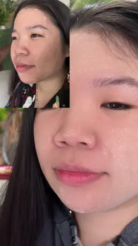 🌻✨ Thoa tinh chất hút sắc tố sau 7 ngày 