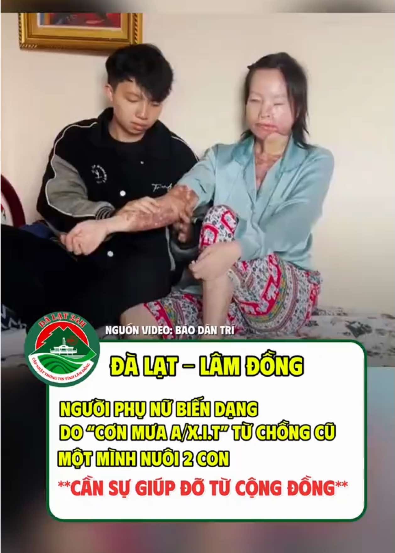 Người phụ nữ biến dạng vì sự ra tay của chồng cũ. Hiện đang cần giúp đỡ tại Đà Lạt, Lâm Đồng #dalat #lamdong #dalat24h #tintuc #giupdo 