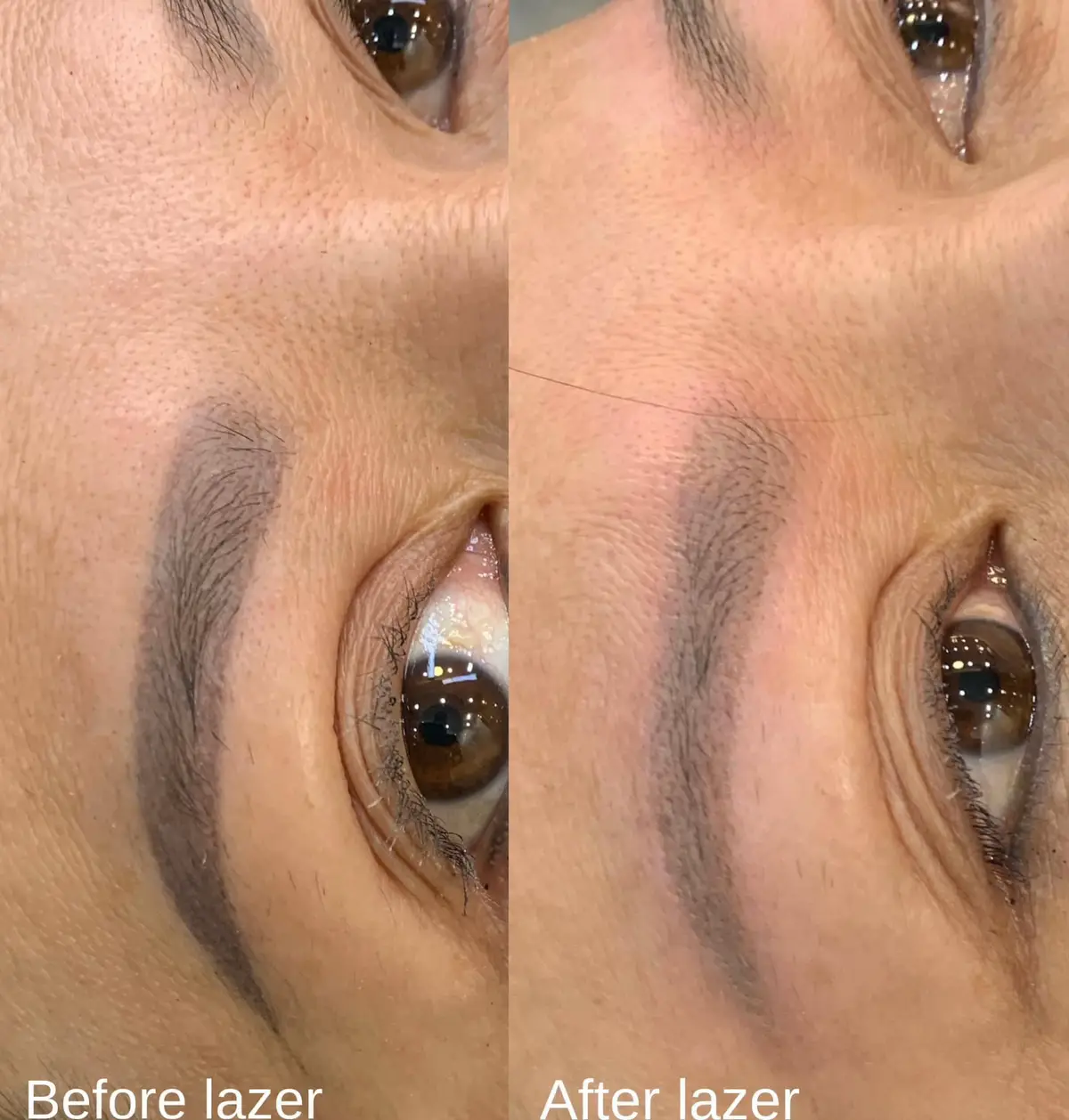 Xóa mày bên e  Lần 1