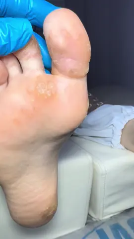Проблема ВПЧ продолжение в профиле, на видео первый прием (промежуточный результат уже есть)