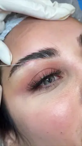 #eyebrows #transplante #📩 #пересадкабровей #трансплантацияволос 