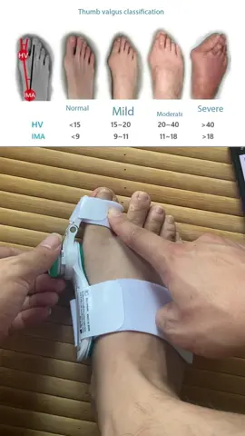 Bunion Correction #bunioncorrector #footcare #toecorrector #tiktok #tiktokmademebuyit 