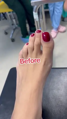 Toes shortening surgery in Morocco  #plasticsurgery #pedicure #nails #visit_morocco 