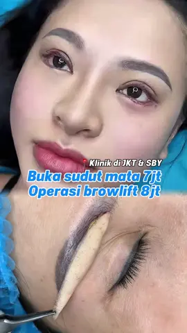 Operasi buka sudut mata 7jt Operasi browlift 8jt👁️ sudah all in (Semua termasuk, tidak ada biaya tersembunyi)  📍di Jakarta dan Surabaya  #opjakarta #opsurabaya #ophidung #oplipatanmata #bukasudutmata 