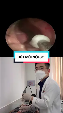 Hút dịch mũi xoang nội soi cho trường hợp viêm xoang cấp #viemxoang #hutmui #noisoi #taimuihong #bstuananh 