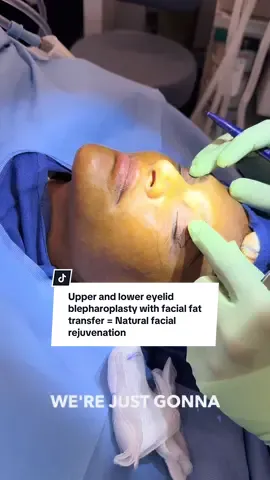 Combining upper and lower eyelid blepharoplasty with facial fat transfer under local anesthesia offers a powerful yet natural facial rejuvenation. Upper lids are lifted and excess skin removed Lower bags and hollows are smoothed Fat transfer restores youthful volume to the midface Done comfortably under local anesthesia, this combination addresses skin laxity and volume loss in one sate, efficient procedure-with minimal downtime and no need for general anesthesia.