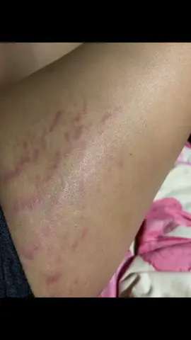 No more stretch marks Organic Skin Beauty oil #fy #affiliatetiktok #trending 