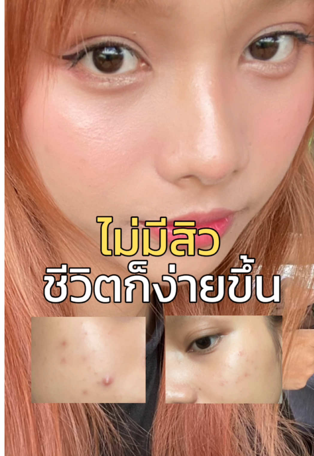 ไม่ มี สิว มันดีแบบนี้เองหรอเนี่ย😳 #เป็นสิวใช้อะไรดี #ครีมลางสาด #สกินแคร์สิว #สิว #iblancbbtt 