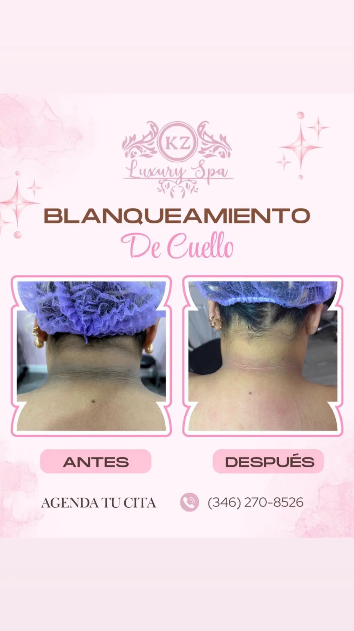 Resultados garantizados no mal gastes tu dinero y ven con professionals que te eliminaran esas manchas Oscuras en tu cuello, recuerda lo barato sale caro, y lo costoso es duradero 🥰🙏