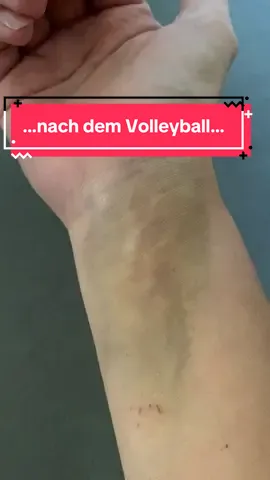 Was mach ich bloß falsch??? Jedesmal endet Volleyball bei mir so. Und meinen Mitspielern geht’s blendend 😳 #volleyball #sportok #hämatom #schmerz #tipsandtricks 