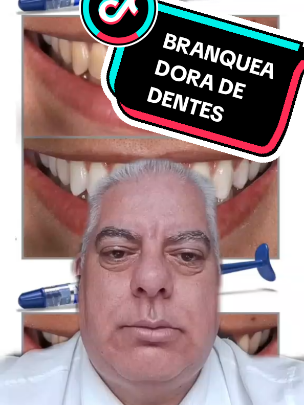 Transforme seu sorriso em minuto. Kit Solução Caseira de Branqueadora de Dentes* - *Branqueie seus dentes de forma segura e eficaz* - *Ingredientes naturais e suaves* - *Fácil de usar e aplicar #higienebucal #dente #dentista #magazinemacedoplus 