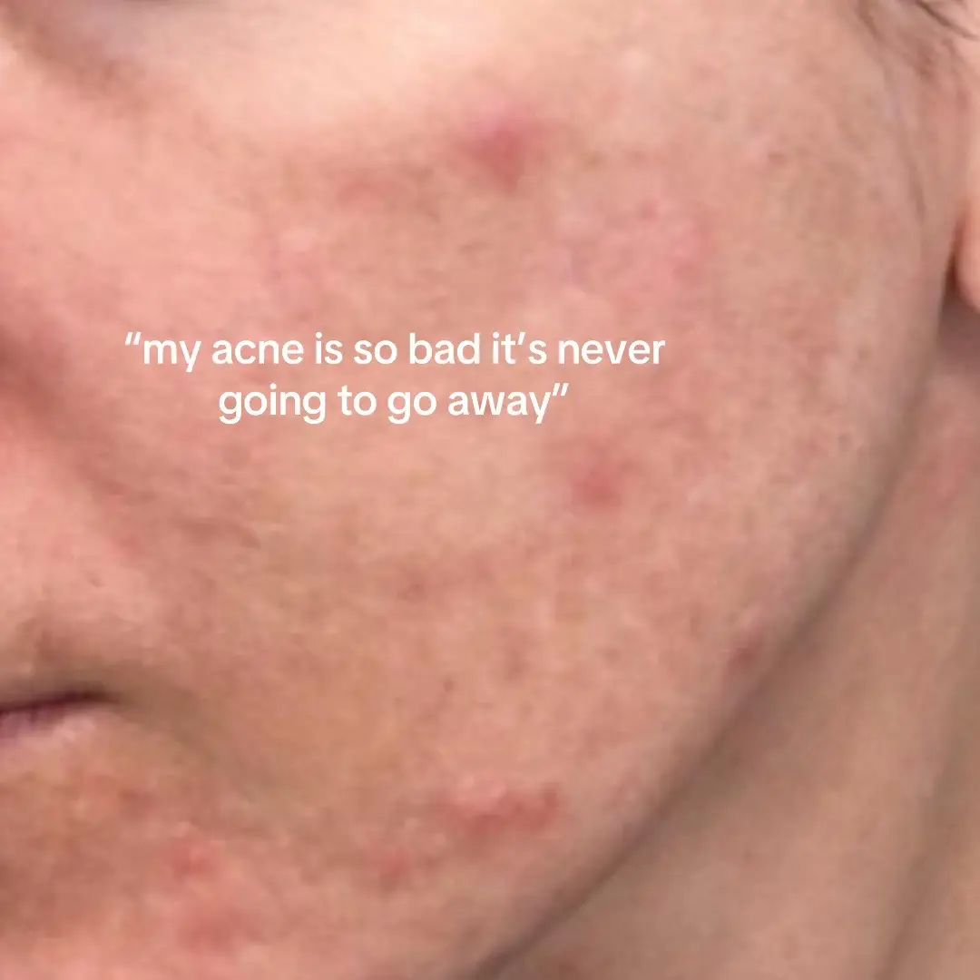 #skincarejourney #acne #foryou 