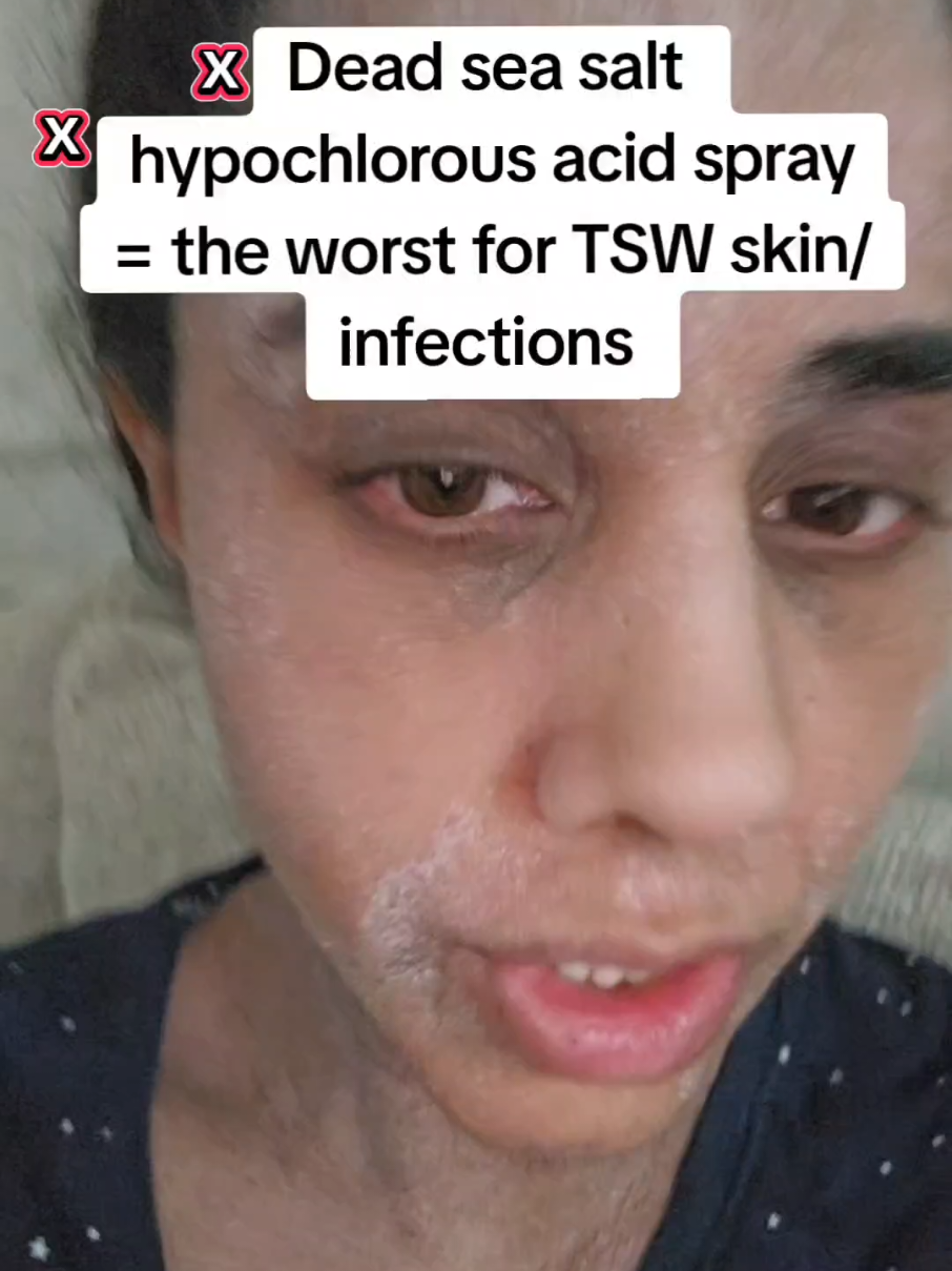 ** non- iodised sea salt** the one I use: https://amzn.eu/d/4tXQE4D DSS and hypochlorous acid arent the best for TSW skin/infection. Dead sea salts have there place in another way and hypochlorous acid is just a big no no imo. #tsw #skininfection #deadseasalt #hypochlorousacid #tswawareness 