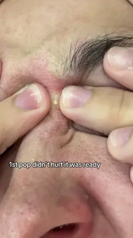 There was 3 pops 😩 #pimplepopping #satisfying #viral 