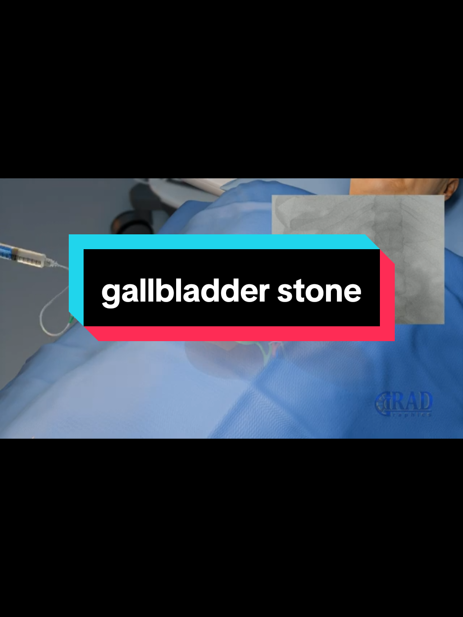 gallbladder stones😢#foryou #drnasrullah #foruyou #100k #500k #1millionaudition #foryoupage❤️❤️ #please #unfreezemyacount #tik_tok #fyp #videoviral #py #pyp #pypシ 