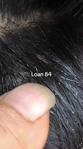 clean lice #lice #😱😱😱 #omg😱😱 #omg😱😱 #trending 