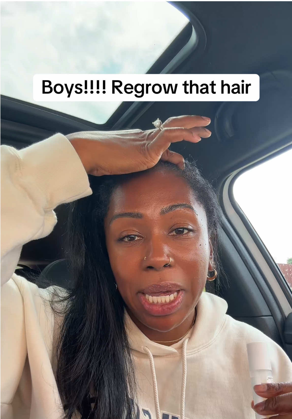 hair regrowth is possible @Bodywise #bodywisehairgrowthserum #recedinghairline #hairline #regrowth #hairgrowthjourney 