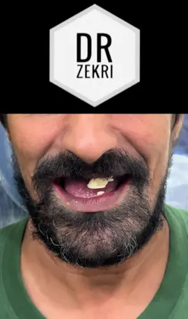 من كندا للجزائر على جال زراعة الاسنان ❤️