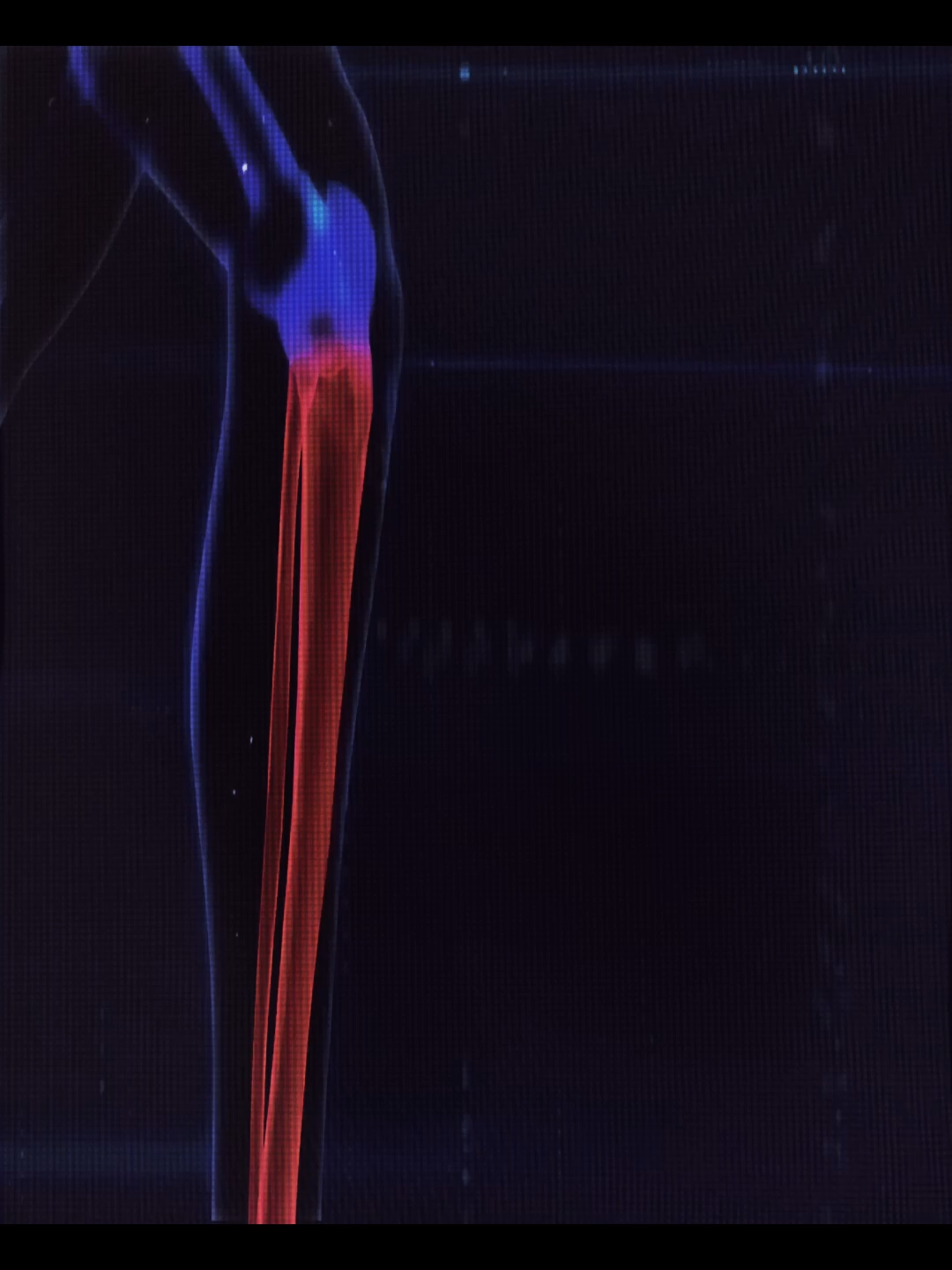 Limb Lengthening surgery edit. The last resort for manlets. #bp #looksmax #looksmaxing #lookism #psl