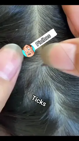 #pimple #viral #fly #satisfatório #asmr  