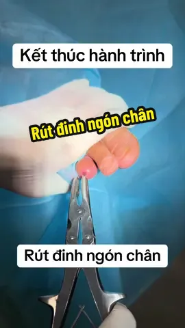 Rút đinh ngón chân sau gãy xương, không cần tê #rutdinh #bacsicoxuongkhop #bacsichanthuongchinhhinh #nguyenviettan #chanthuongthethao #viembaogan #thoaihoakhopgoi #buouhoatdich #rachsunchem #benhvienchanthuongchinhhinh 