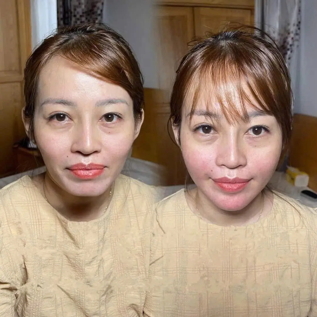 2-9 này chị muốn bạn bè phải trầm trồ được khum e 💉#Môi_nâng_cao #botox_nâng_cao #Mdcodes 