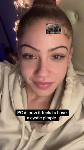 Love that it gave me this sound just for zooming in on the poor thing hahahah I’ve just accepted TikTok uses the term point of view wrong at this point.also it only pops up on my head and chin every once in a while but so painful omg.  #pov #pimple 