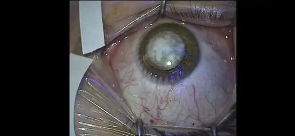 L.A.S.I.K surgery. procedure of a LASIK surgery.  #wtfmoments #wtf #surgery 