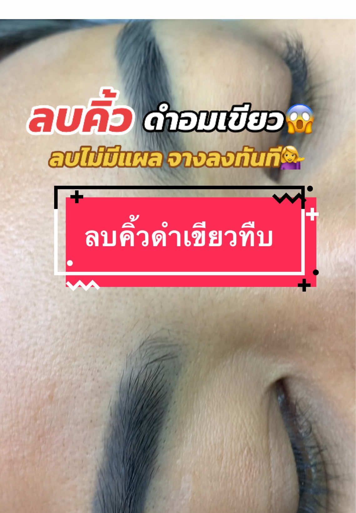 ลบคิ้วดำเขียวทืบ ลบไม่มีแผล โดนน้ำได้ เขียนคิ้วทับได้ สีจางลงทันที #อาจารย์เต๋าสักคิ้วเชียงราย #ลบคิ้วเชียงราย #ลบคิ้วด้วยเลเซอร์เชียงราย #ลบคิ้วดำเชียงราย #ลบคิ้วถาวรเชียงราย 