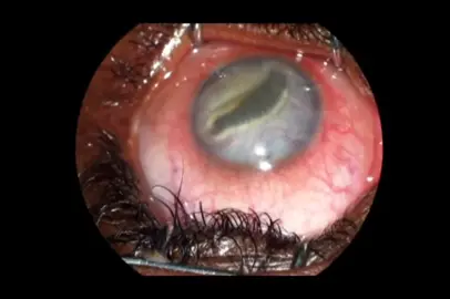 Parasite in the eye removal.  Ocular pentastomiasis. #wtf #surgery #wtfmoments #parasite 