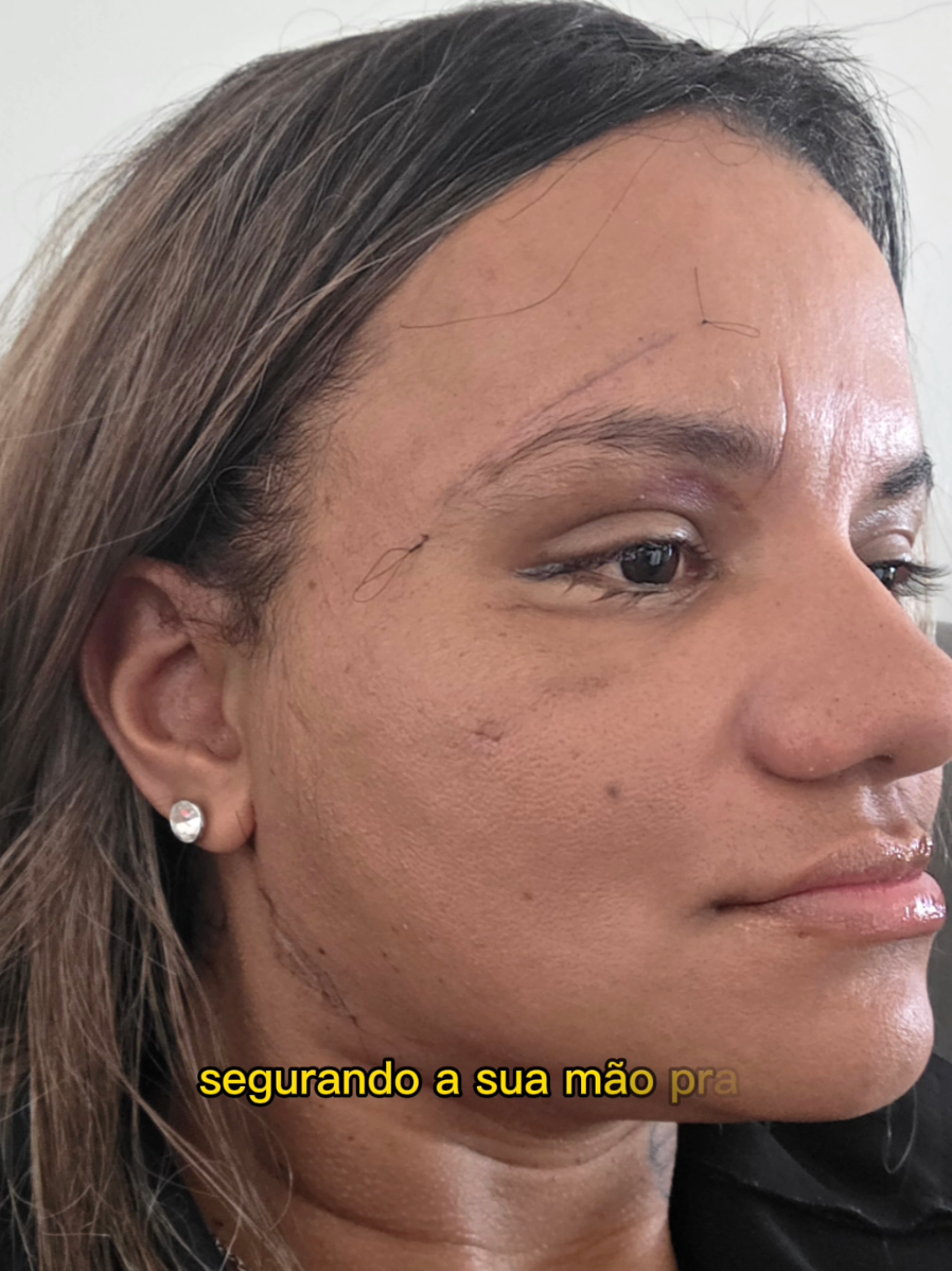 30 dias de pós-cirúrgico ♡ Obrigada a todas manifestações de carinho, solidariedade e homenagens. abraço e agradecimento especial pelo cirurgião buco maxilar Dr Kerlison Paulino e todos os residentes do huol,bem como toda a equipe  que durante o tempo de internação, garantiu um tratamento humanizado. Viva o SUS. Ainda é muito cedo para avaliar os resultados, ainda tenho edemas e o resultado final so vem mesmo com 6 meses de pós cirúrgico. Esse vídeo tem como objetivo dizer e mostrar que 