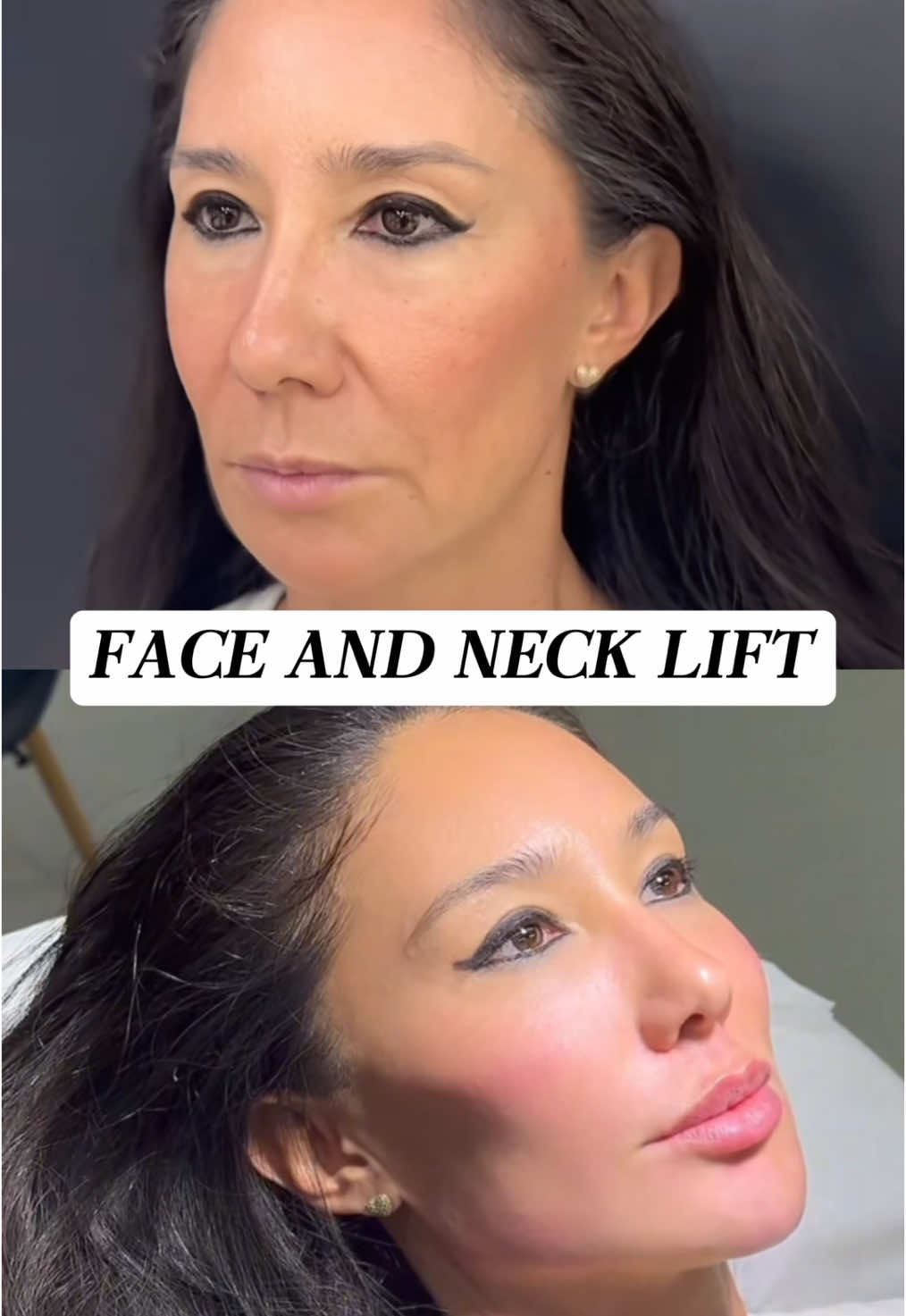 “Why do I look older in photos than in the mirror?” Because sagging shows more clearly on camera. The mini-incision SMAS facelift redefines your contours, so photos reflect the real, youthful you. #facelift #MiniSMASLift #FacialLineImprovement #NaturalRejuvenation #SaggingCare #YouthfulContours