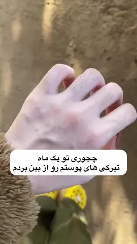 � هِی خوشگلِ دوست‌داشتنی! تاحالا آرزو کردی یه کرم داشته باشی که همه‌چی باشه؟ 😫 آبرسان باشه؟ ✅ ضد جوش و لک باشه؟ ✅ منافذتو جمع کنه؟ ✅ پوست مرغی رو محو کنه؟ ✅ و از همه مهم‌تر… پوستتو سفید و شیشه‌ای کنه؟! 😍💎 💫 پس سلام به کرم گلوتاتیون، فرشته‌ی کوچولوی پوستت! 🧴🪽 یه ترکیب جادویی از لطافت، پاکی، و درخشش 🌟 📦 همراه با صابون مکمل برای نتیجه‌ی ۲ برابر سریع‌تر! ✨ از پوست خسته و بی‌روح… برس به یه پوست نرم، شفاف، و بدون لک 😚🪞 (اونم فقط توی چند هفته!) 🌸 زیبایی یعنی پوستت نفس بکشه… و این کرم دقیقاً همون چیزیه که دنبالش بودی 💕 📩 برای مشاوره و ثبت سفارش دایرکت بده گلم 💌 (تعداد محدوده، عجله کن 😚