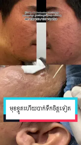 ស្បែកមុខដែលធ្លាប់បាក់ទឹកចិត្ត #drprofessionalclinic #fypシ #skin #co2 #scar 