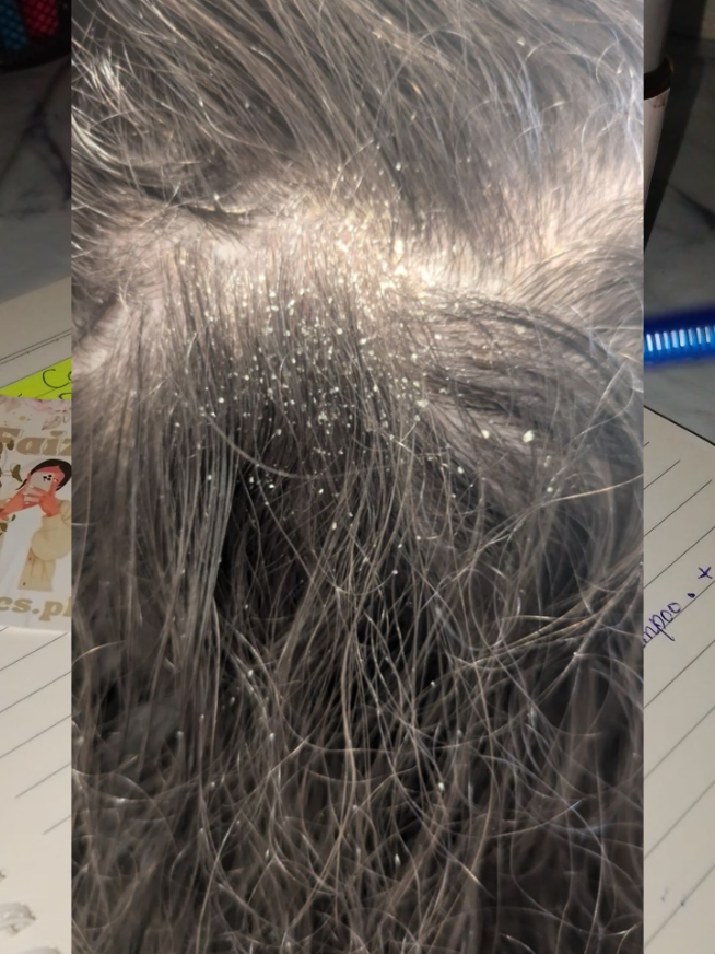 Dandruff control Tips ✔️💯✨ #faizaorganics #dandruffsolution #fasthairgrowth #haircareroutine #dandruff 