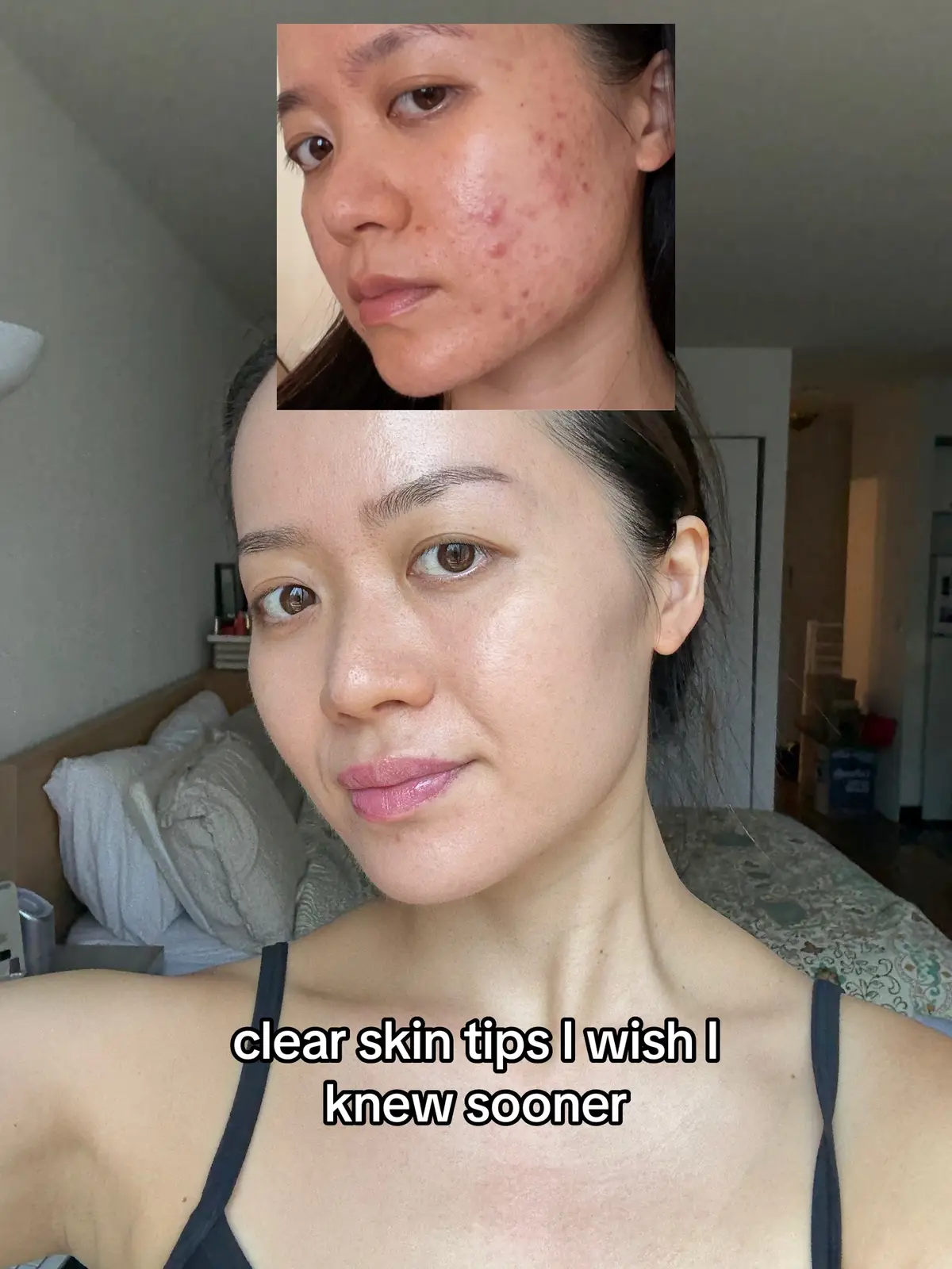 Healing from within >>>  #acnetips #clearskintips #guthealth #acneprone 