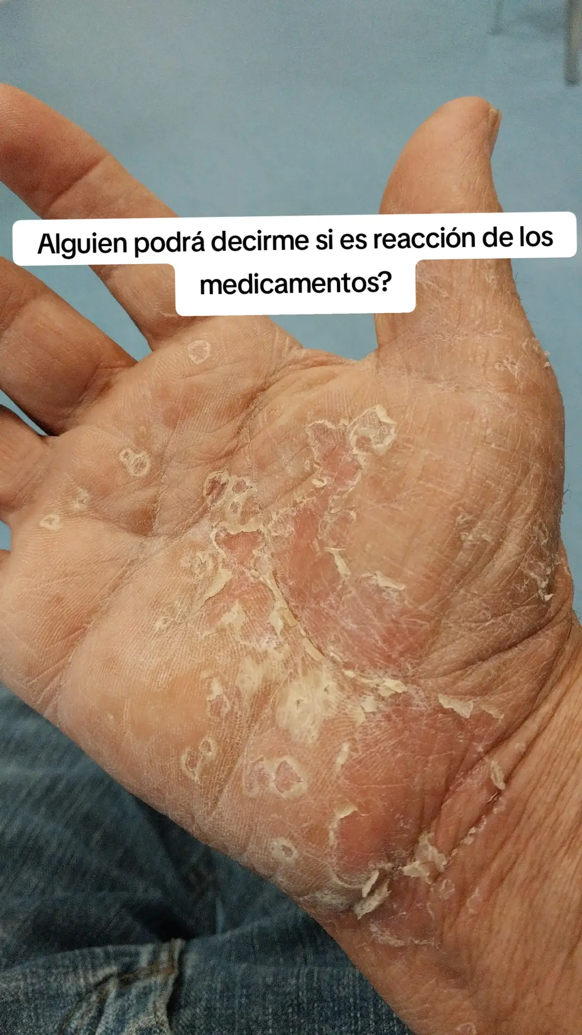 Será alergia o será reacción de los medicamentos que estoy tomando para el dolor de espalda #LIVEIncentiveProgram #GenuineInteractionMatters #PaidPartnership 