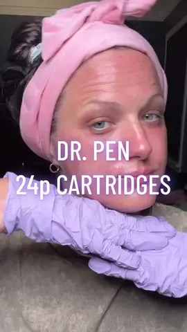 Started with nano needle and moved onto 24 pins! What a difference! If you have questions feel free to ask! @RejuveNest #drpen #microneedling #microneedlingbeforeandafter #antiagingskincare #smoothskingoals 