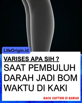 Apa Itu Varises? Kondisi ketika pembuluh darah vena melebar, berliku, dan menonjol di permukaan kulit akibat katup vena melemah. Biasanya muncul di betis dan paha. ⚠️ Faktor Risiko: Berdiri atau duduk terlalu lama Kurang olahraga Obesitas Kehamilan Faktor keturunan Penuaan (usia lanjut → elastisitas pembuluh berkurang) 🔍 Gejala yang Perlu Diwaspadai: Pembuluh darah menonjol seperti ular biru/ungu di kaki Rasa berat / pegal di betis Bengkak di pergelangan kaki Nyeri / panas di area varises Kulit sekitar menghitam atau kering Luka sulit sembuh di kaki 📉 Tahapan Perkembangan: 1️⃣ Awal → hanya tampak spider veins (garis halus seperti jaring laba-laba) 2️⃣ Varises ringan → pembuluh mulai terlihat menonjol, pegal setelah lama berdiri 3️⃣ Varises sedang → pembengkakan, nyeri, kulit mulai berubah warna 4️⃣ Varises berat → ulkus (luka terbuka), pembekuan darah, komplikasi serius 💉 Terapi Umum & Pendukung: Jaga berat badan ideal Hindari berdiri/duduk terlalu lama Olahraga ringan (jalan kaki, berenang, bersepeda) Gunakan stocking kompresi Dukungan terapi untuk daya tahan tubuh & sirkulasi darah 🛡 Kenapa Varises Berbahaya? ✔️ Awalnya hanya masalah estetika → bisa berkembang jadi penyakit serius ✔️ Risiko luka kronis di kaki (ulkus) ✔️ Bisa timbul pembekuan darah (trombosis) → bahaya kalau lepas ke paru (emboli paru) 📞 Butuh Konsultasi Lebih Lanjut? 👉 Hubungi: 0855-9118-6101 #Varises #KesehatanKaki #PembuluhDarah #EdukasiKesehatan #cegahsejakdini 
