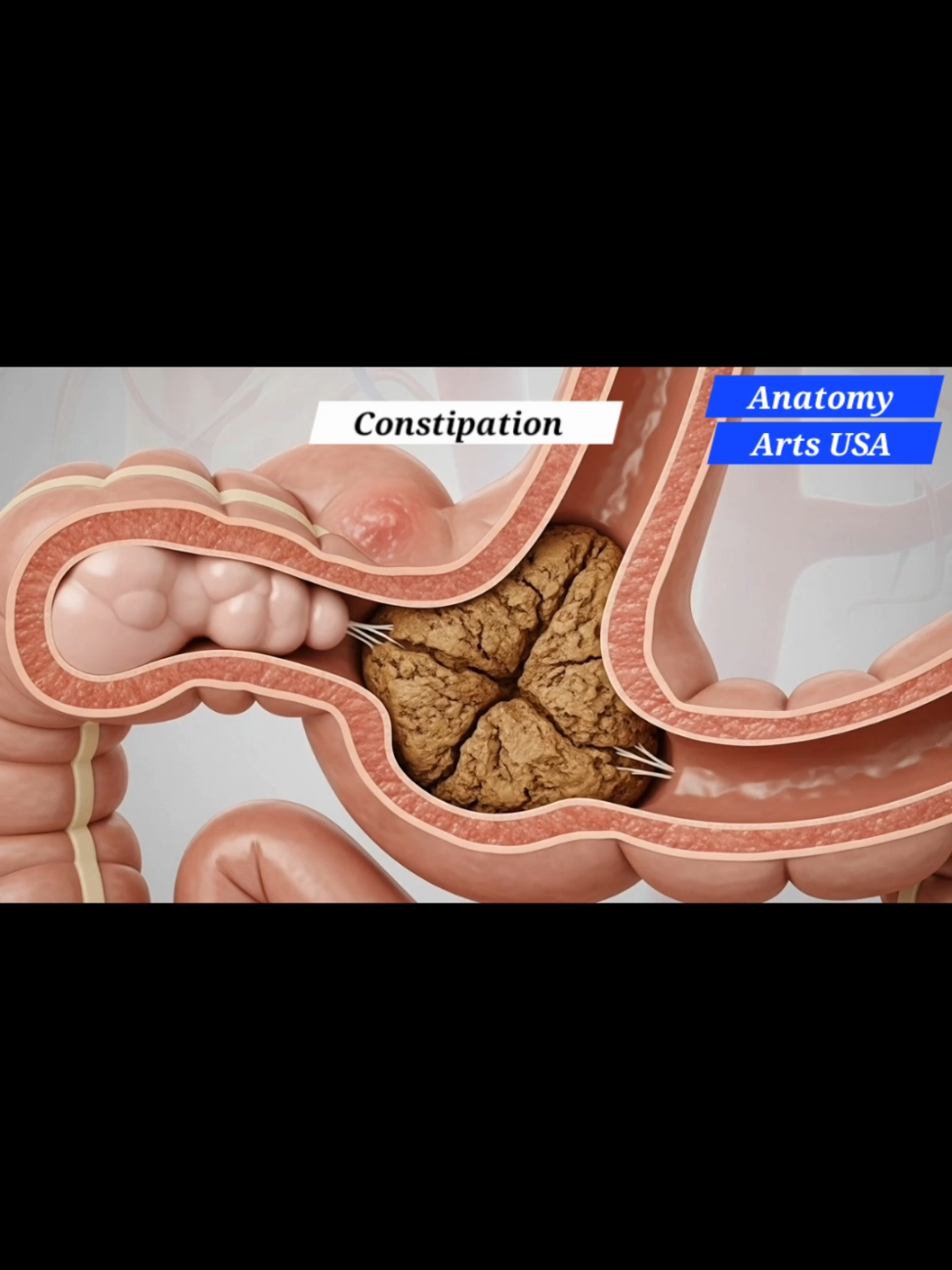 Constipation In Cross-sectional View | Gut Health  Speed through the human digestive tract with AI-powered visuals and smooth narration. Great for last-minute reviews and U.S.-focused medical education. Digestive journey, human body animation, anatomy crash course, ai-generated, us biology education “medical animation” “pre med study” “nursing school anatomy” “MCAT biology” “U.S. healthcare system” “AI-generated anatomy Disclaimer:The content on Anatomy AI Arts is created for educational, informational, and entertainment purposes only. All images, animations, and videos are generated using AI tools and should not be interpreted as professional medical advice, diagnosis, or treatment. For any medical concerns, always seek guidance from a qualified healthcare provider. While we aim for accuracy, AI-generated content may contain errors, artistic interpretations, or simplifications. The channel owner does not assume liability for any decisions made based on this content. This channel may include ads or affiliate links as part of its revenue model. All views and visuals are presented as artistic and educational  purposes.  #Constipation #GutHealth #DigestiveSystem #HealthFacts #AnatomyArt   