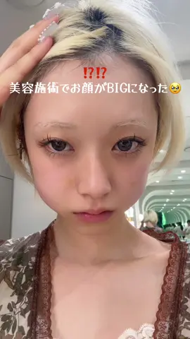 このお顔治るか心配すぎたけど３日くらいしたら元通り〜❗️ だんだんお顔引き締まるのが楽しみ⭐️💭 @priaclinic_jp クリニックはココ!とっても丁寧でおすすめだよ#韓国クリニック #美容施術 #韓国美容 #オンダリフト #脂肪溶解注射