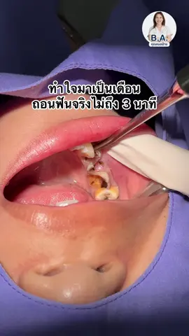 คุณหมอมือเบามากกก✨🦷 #ถอนฟัน #ถอนฟันไม่เจ็บ #คลินิกทันตกรรมบีเอปทุมธานี #หมอฟันtiktok 