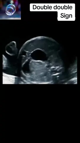 Double double Sign on ultrasound #radiology #ultrasound #radiologist #baby #pregnancy 