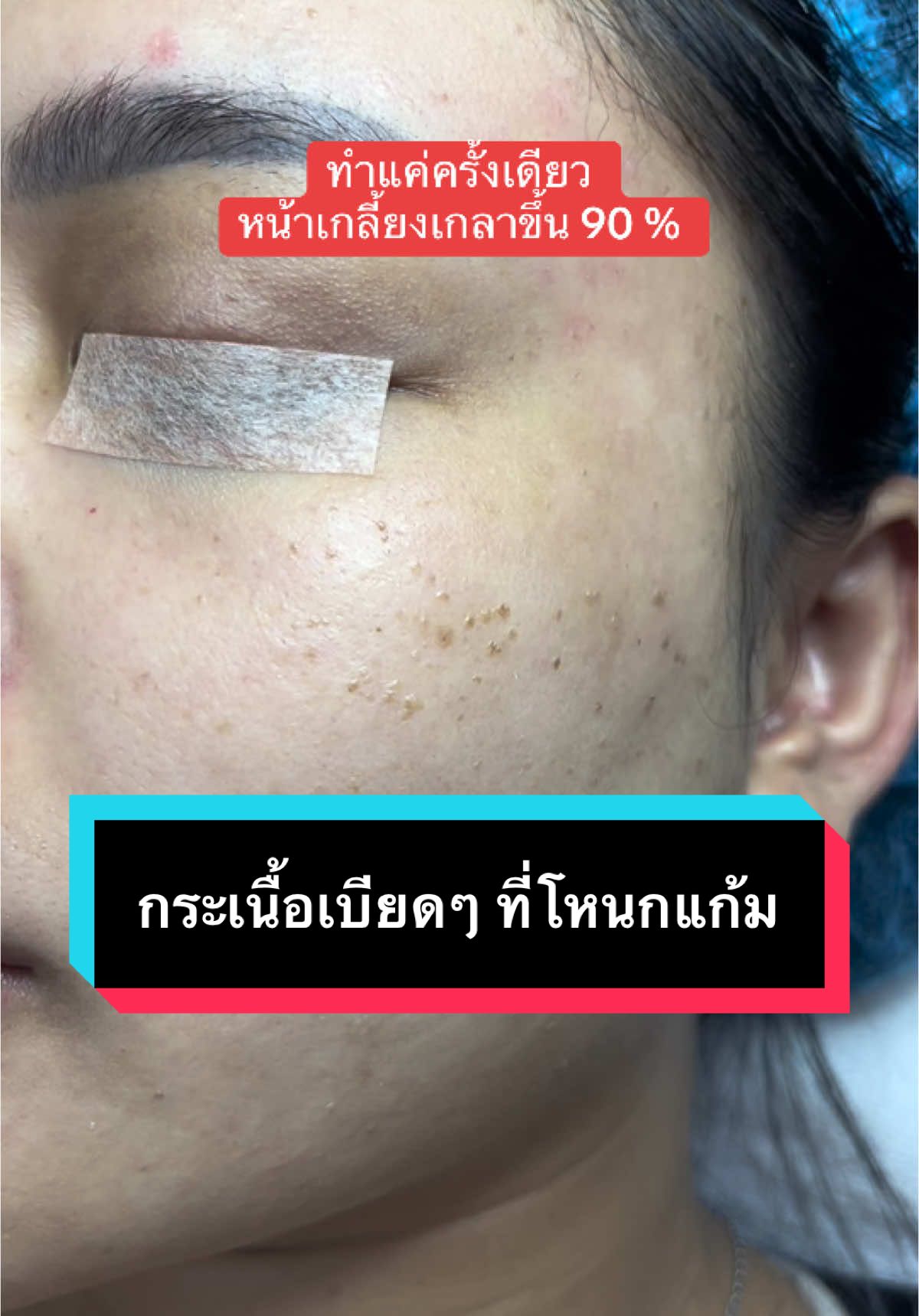 ❌ไม่ใช้เครื่องจี้จีนที่ขายตามท้องตลาด  เราใช้เลเซอร์Co2 เท่านั้น เพราะแม่นยำ และไม่ทำลายเนื้อเยื่อรอบข้าง #เลเซอร์co2 #เลเซอร์กระเนื้อ #จี้กระเนื้อ #กระเนื้อ #เลเซอร์ติ่งเนื้อ #จี้ติ่งเนื้อ #พีแองเจิลคลินิก #ไม่เป็นแผลเป็น #เลเซอร์ไฝ #ไฝ #เลเซอร์ต่อมไขมัน 