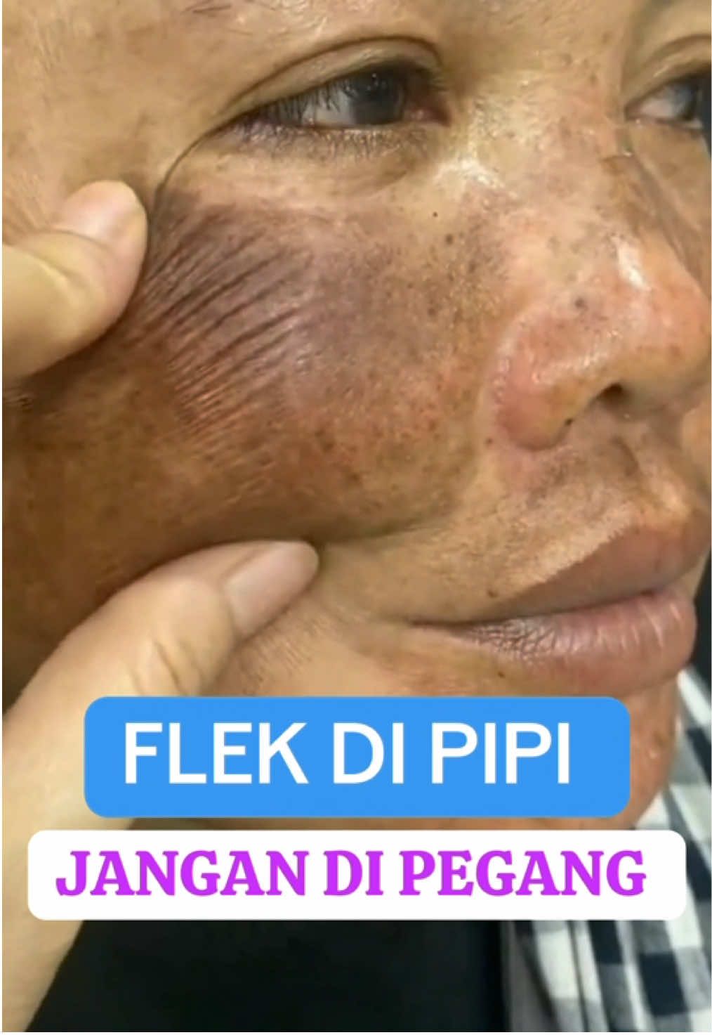 Flek hitam #flekhitam #flek #DIY 