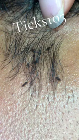 Remove lice #😭😭😭 #😱😱😱omg #liceremoval #🥶🥶🥶 #like 