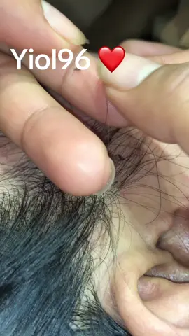 Remove lice #omg🙀🙀🥶🥶🥶😱❤️❤️ #lice #liceremoval 