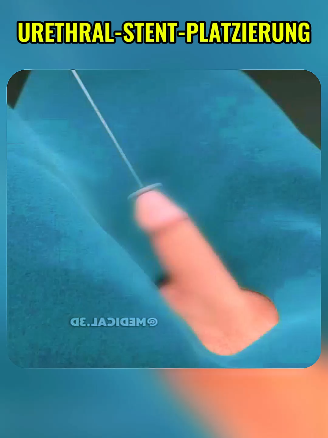 Urethral-Stent-Platzierung #medicaltok #anatomy #medicine #surgery #lapeyronie #LearnOnTikTok #3danimation