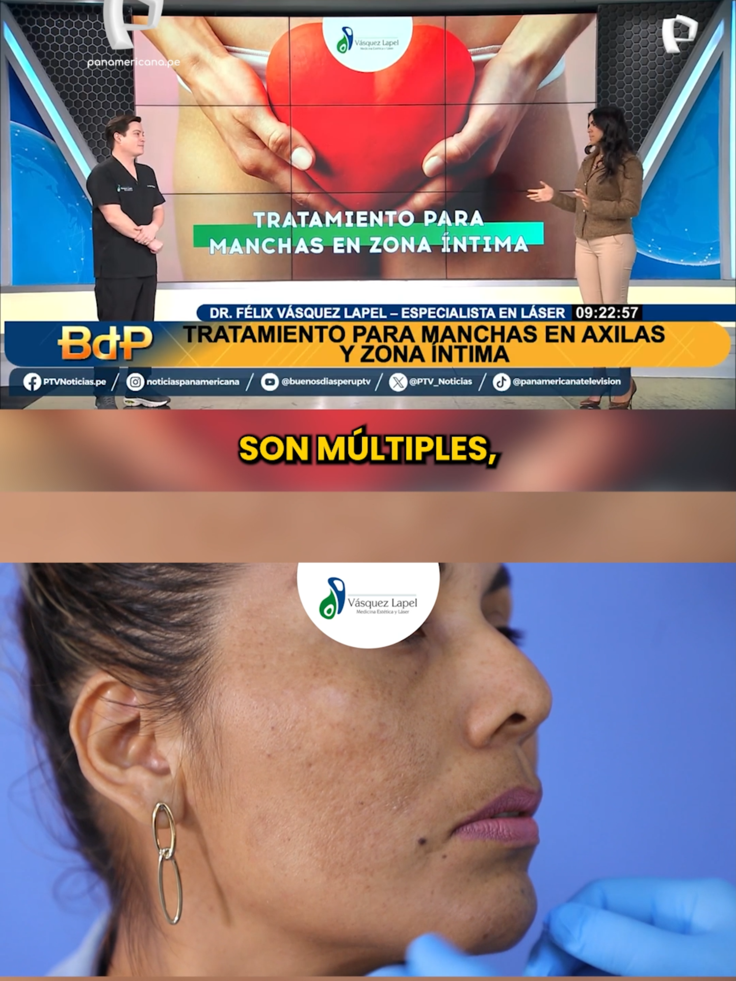 💖 Láser para eliminar manchas en la piel: un tratamiento seguro y sin cicatrices ✨ El Dr. Félix Vázquez, de la Clínica Vázquez Lapel, explica que el tratamiento con láser es un procedimiento seguro y sin cicatrices para eliminar manchas causadas por el sol, acné o cambios hormonales. La duración del tratamiento varía según la mancha, y el uso de protector solar es clave para evitar que vuelvan a aparecer. 📆 Citas disponibles hoy mismo ¡reserva ya! #Láser #PielSana #Manchas #Dermatología #ClínicaVázquezLapel #DermatologíaAvanzada #ConfianzaEnTuPiel